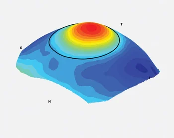 scleral contact lenses custom design for keratoconus